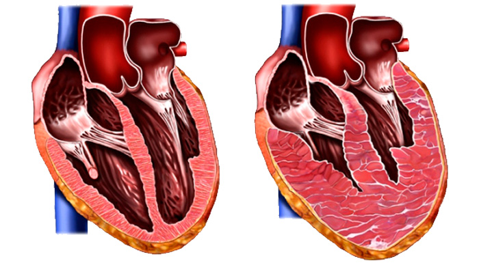 Coração normal e na hipertrofia cardíaca.
